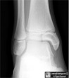 Salter Harris Type III Fracture
